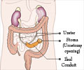 Urinary Diversion 