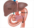 Whipples Surgical Procedure (Pancreaticoduodenectomy) for Cancer of Head of Pancreas