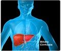 Biliary Cirrhosis