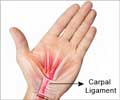 Carpal Tunnel Syndrome