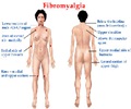 Fibromyalgia - Support Groups