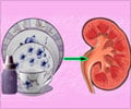 Kidney Failure due to Melamine Toxicity