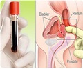 Prostate Cancer Screening