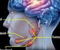 Salivary Gland Cancer