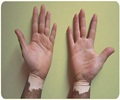 Vitiligo