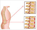 Ankylosing Spondylitis