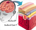 Arachnoid Cysts