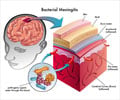 Bacterial Meningitis