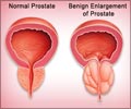 Benign Prostatic Hyperplasia