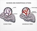 Brain Hemorrhage Vs Stroke: Understanding the Differences
