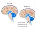 Chiari Malformations