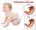 Pediatric Pyloric Stenosis