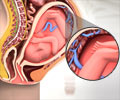 Chorioangioma