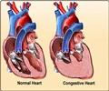 Congestive Heart Failure