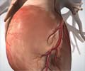 Coronary Artery Bypass Grafting 