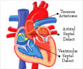 Cyanotic Heart Disease