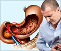 Digestive Tract Ulcers Symptom Evaluation