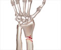 Distal Radius Fracture