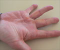 Dupuytrens Contracture