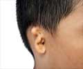 Ear Deformities