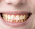 Fluorosis