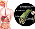 Gallstones