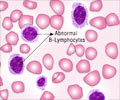 Hairy Cell Leukemia