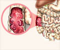 Inflammatory Bowel Disease