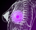 Inflammatory Breast Cancer