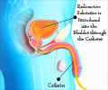 Isotope Cystogram