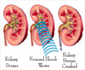 Lithotripsy or Extracorporeal Shock Wave Lithotripsy (ESWL)