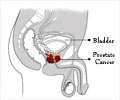 Medical Management of Prostate Cancer