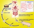 Neurocysticercosis