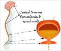 Neurogenic Bladder