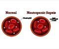 Neutropenic Sepsis