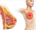 Pagets disease of the breast