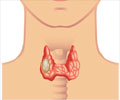 Papillary Thyroid Cancer