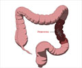 Pinworm Infection
