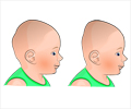 Plagiocephaly