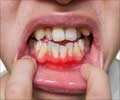 Drug-Induced Gingival Hyperplasia