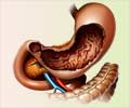 Pyloric Stenosis in Adults 