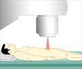 External Beam Radiation Therapy for Prostate Cancer