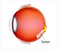 Retinoblastoma