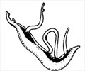 Schistosomiasis