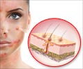 Skin Pigmentation Disorders