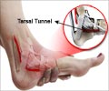 Tarsal Tunnel Syndrome