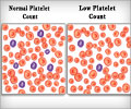 Thrombocytopenia