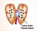 Thymoma and Thymic Carcinoma