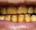 Tooth Discoloration