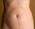 Tummy Tuck or Abdominoplasty